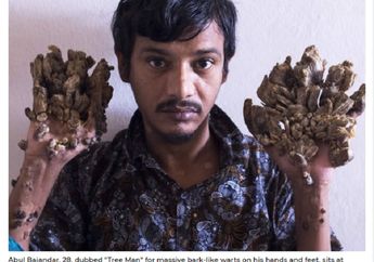 Kisah Si 'Manusia Pohon', Pilih Tangannya Diamputasi Sebab Tak Kuasa Menahan Rasa Sakit, 'Saya Meminta Para Dokter untuk Memotong Tangan Saya...'