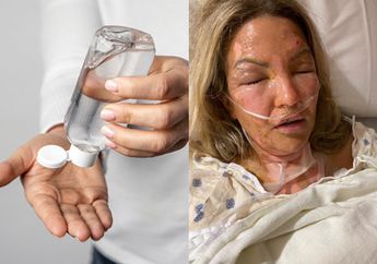 Jangan Pernah Taruh Hand Sanitizer di Dekat Api, Perempuan Ini Alami Luka Bakar Parah Gara-Gara Lalai