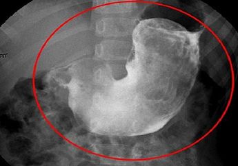 Sering Makan Rambutnya Sendiri, Ditemukan Gumpalan Rambut Seberat 7 Kg di Dalam Perut Remaja 17 Tahun Ini, Ternyata Dia Idap Kondisi Medis Langka Ini