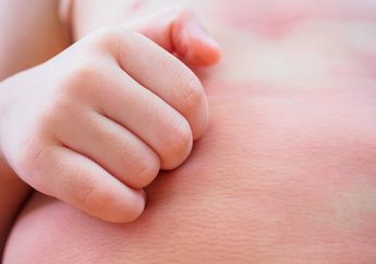 Sudah Minum Obat Tapi Biduran Tak Kunjung Sembuh? Ini Sederet Makanan untuk Melawan Alergi yang Ampuh dan Aman Dikonsumsi