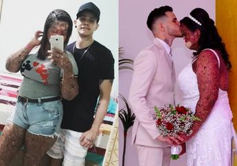 Tetap Cinta Meski Tampilan Fisik Pasangannya Tidak Sempurna, Pria ini Tulus Nikahi Gadis dengan Kelainan Kulit Langka