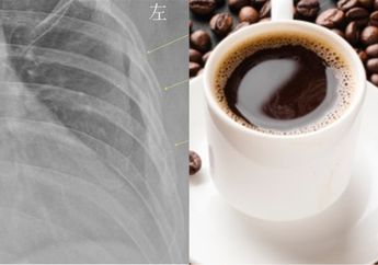 Keenakan Minum Kopi 10 Cangkir Setiap Hari, Wanita 30 Tahun Ini Harus Terima Pil Pahit Lantaran Tulangnya Keropos Sampai Ada yang Patah