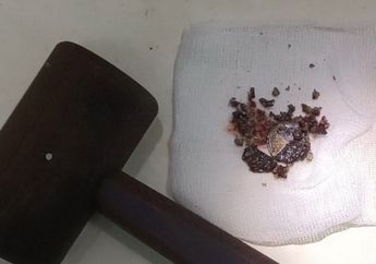 Lupa Pernah Dorong Koin ke Hidung Saat Berusia 6 Tahun, Pria Ini Baru Sadar 53 Tahun Kemudian