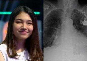 Melisha Sidabutar Meninggal Dunia Disebabkan Pembengkakan Jantung, Kenali Penyebab dan Gejalanya!