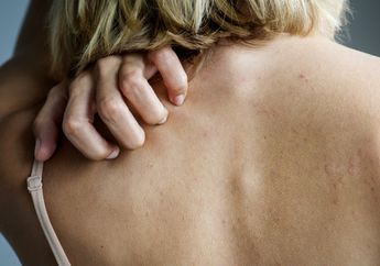 Cara Ampuh Menghilangkan Jerawat Badan Agar Kulit Kembali Mulus!