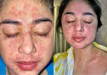 Mengenal Ruam Kulit yang Dialami Dewi Perssik Saat Positif Covid-19, Ini Gejalanya!