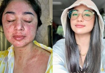 Alami Gejala Covid-19 Langka hingga Bikin Wajah Mulusnya Dipenuhi Bercak Merah, Dewi Perssik Kuak Alasan Lakukan Isolasi Mandiri di Rumah: Aku Nggak Mau Jadi Orang yang Berdosa