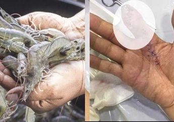 Ibu-ibu Satu Indonesia Wajib Tahu, Tertusuk Ekor Udang Saat Sedang Mencucinya, Pria Ini Alami Hal Mengerikan pada Jarinya, Sampai Diamputasi Gegara Hal ini?