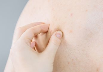 Tujuh Tips Ampuh Menghilangkan Jerawat di Punggung Secara Alami, Udah Kamu Coba?