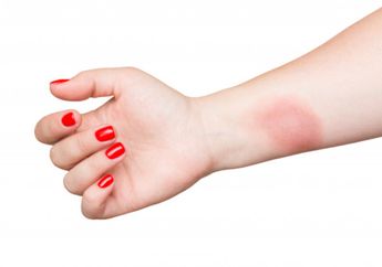 Kulitmu Terbakar? Jangan Sekali-kali Oleskan Pasta Gigi, Coba Gunakan Bahan Alami Rumahan yang Murah Meriah Ini!