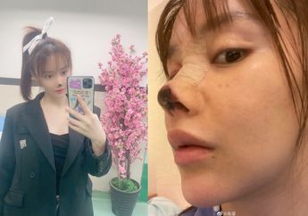 Mengidamkan Hidung Mancung Tapi Berujung Cacat, Aktris Cantik Ini Diduga Jadi Korban Malpraktik