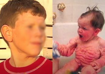 Lahir ke Dunia dengan Kondisi Kulitnya Dipenuhi Kerutan, Transformasi Fisik Bocah Laki-laki ini Berubah Menakjubkan!