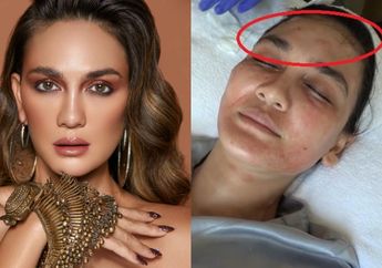 Punya Paras Cantik Paripurna, Luna Maya Tak Segan Lakukan Treatment Khusus hingga Rela Wajahnya Bentol-bentol Usai Lakukan Perawatan Vampire, Apa Bahayanya?
