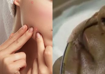 Pria ini Hampir Kehilangan Nyawa Usai Sembarangan Pencet Jerawat di Kulitnya, Dokter Peringatkan Segitiga Mematikan pada Wajah