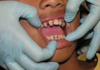 Arti Mimpi Gigi Rusak yang Lekat dengan Kesan Pembawa Sial, Ternyata ini 4 Makna Tersembunyi di Bunga Tidur