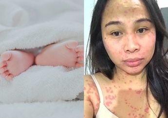 Ibunya Pakai Obat Pemutih Abal-abal, Anaknya yang Masih Bayi Alami Kondisi Mengerikan Ini