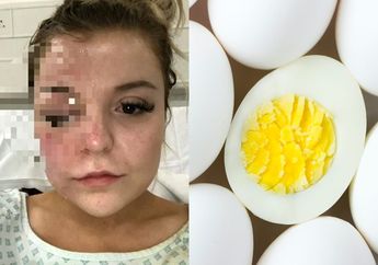 Gadis Muda Alami Luka Bakar Hingga Matanya Bengkak Gegara Masak Telur, Hal yang Sering Dianggap Sepele ini Jadi Pemicunya