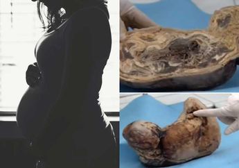Hamil Selama 46 Tahun Tanpa Menjalani Persalinan, Dokter Tidak Percaya dengan Kondisi Bayi di Dalam Kandungan Wanita ini