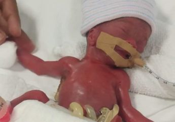 Heboh Bayi Teringan di Dunia, Lahir Prematur dengan Berat 212 Gram, Begini Kondisinya Setelah 14 Bulan Berlalu