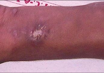 Waduh, Jangan Ditiru ya! Gegara Ingin Jadi Superhero Bak di Komik Marvel, Remaja 15 Tahun Asal India Nekat Suntikkan Hal Berbahaya Ini ke dalam Tubuhnya