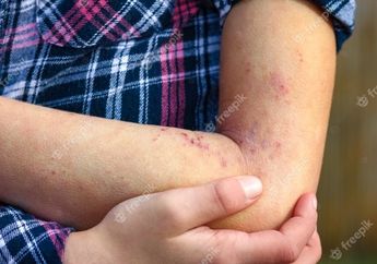 Nyesel Baru Tahu, Ternyata Semudah Ini Menyembuhkan Eksim Pada Kulit Tanpa Biaya Mahal