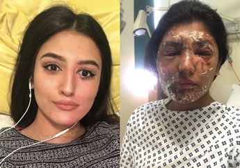 Wajahnya Disiram Air Keras hingga Melepuh di Hari Ulang Tahunnya, Begini Curhatan Pilu Artis Cantik Ini