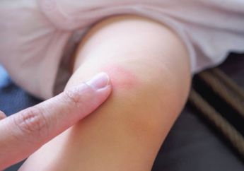 Nyesel Banget Baru Tahu Sekarang, Ternyata Mengobati Gigitan Nyamuk pada Bayi Bisa Pakai 7 Bahan Alami Ini, si Kecil Nggak Rewel Lagi!