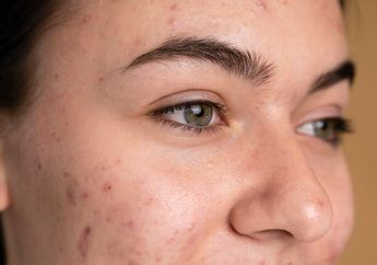 Kalau Dibiarkan Bisa Timbulkan Jerawat, Begini Cara Sederhana Mengatasi Pori-pori Besar Cuma Pakai Bahan Dapur!