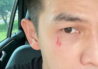 Arti Mimpi Luka di Wajah Melambangkan Emosi yang Sangat Kuat, Waspada dengan Obsesi dan Rasa Panik