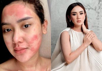 Divonis Mengidap Autoimun Gegara Kebiasaan Suntik Putih dan Vitamin, Pedangdut Cantik ini Kapok dan Memilih Lakukan Hal ini Untuk Jaga Penampilan