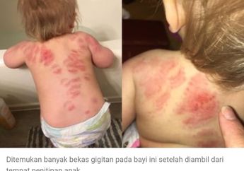Syok! Seorang Ibu Temukan Lebih dari 25 Bekas Gigitan di Tubuh Putrinya Usai Dijemput dari Penitipan Anak