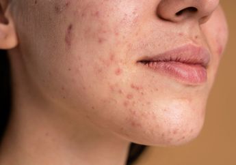 Tips Mencegah Timbulnya Jerawat Pada Kulit Kering, Apa Saja yang Harus Dilakukan?