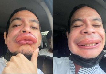 Selesai Mandi Tak Sadar Ada Serangga Hinggap di Handuknya, Aktor Ini Syok Mendapati Bibirnya Langsung Bengkak Akibat Tersengat Tawon, Bukannya Malu Malah Pamer di Sosmed
