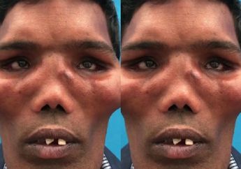 20 Tahun Hidup Dengan Wajah Tak Lazim, Pria Ini Buat Semua Orang Melongo Setelah Dokter Lakukan Ini Pada Wajahnya