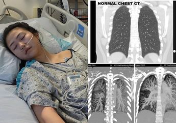 Tak Pernah Rasakan Gejala, Paru-paru Gadis 19 Tahun ini Rusak Parah karena Gunakan Vape, Dokter Sampai Angkat Tangan Lihat Kondisinya