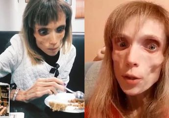 Tubuhnya Hanya Tersisa Kulit dan Tulang, Penderita Anoreksia ini Hanya Makan Sepotong Apel dan Air, Dokter Sampai Ngeri Melihatnya