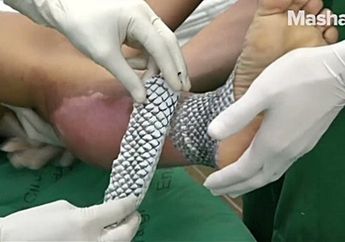 Nekat Lakukan Operasi Vagina Pakai Membran Ikan Nila, Transgender Ini Klaim Hasilnya Sangat Memuaskan, Bisa Berhubungan Seks dengan Norma!