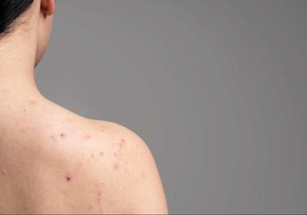 Tanpa Obat dan Perawatan Mahal, Ini Cara Ampuh Menghilangkan Jerawat Punggung yang Bikin Nggak Pede!