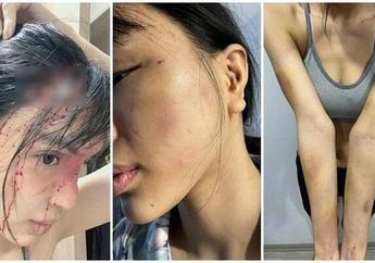 Diserang dan Dianiaya hingga Berdarah-darah, Model Cantik Ini Laporkan sang Tunangan yang Suka Main Tangan Atas Kasus Penyerangan, Begini Kronologinya!