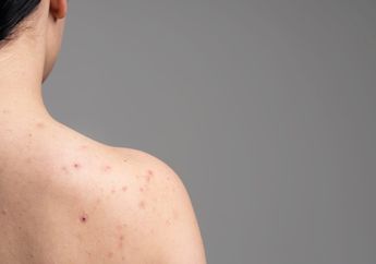 Kandungan Skincare yang Dapat Menghilangkan Jerawat Punggung Secara Efektif, Apa Saja?