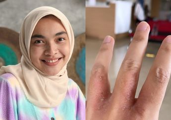 Jangan Tunggu Sampai Harus ke Dokter Kulit Seperti Tika Bravani, Ibu-ibu Ternyata Begini Cara Mencegah Tangan Kasar Karena Mencuci Piring