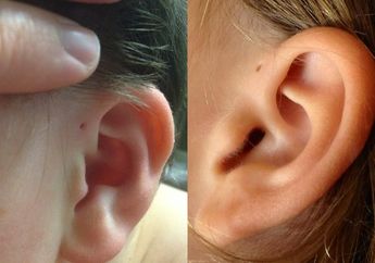 Gak Nyangka, Ternyata Ini Fungsi Lubang Kecil yang ada pada Telinga!