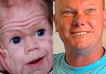 Saat Lahir Sekujur Tubuhnya Sudah Dipenuhi Keriput dengan Wajah Menyeramkan, Penampilan Terbaru Bayi Ini di Masa Dewasa Justru Bikin Melongo