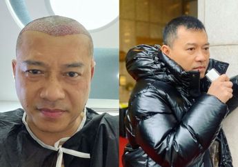 Mengenal Transplantasi Rambut yang Dilakukan Anang Hermansyah sampai Kevin Aprilio, Ternyata Ada 4 Kondisi Orang yang Tidak Boleh Melakukan Prosedur Ini!