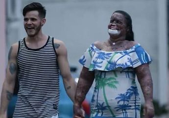 Cuma Butuh Cinta, Pria ini Tidak Pandang Fisik Istrinya yang Alami Penyakit Kulit Langka, Begini Kisahnya!