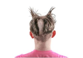 Arti Mimpi Kebotakan Berkaitan dengan Kekhawatiran Tentang Hal yang Sudah Pasti Akan Dihadapi Manusia, Apa Itu?