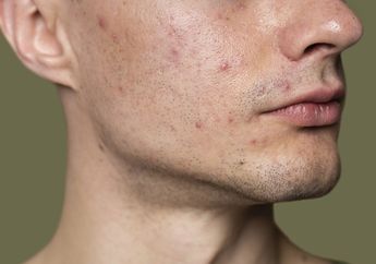 5 Rekomendasi Skincare Pria untuk Menghilangkan Noda Hitam Bekas Jerawat