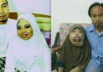 Bak Buktikan Cinta Sejati Tak Termakan Kondisi, Sosok Suami Ini Setia Dampingi sang Istri Meski Idap Penyakit Langka yang Bikin Wajahnya Tak Beraturan
