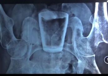 Mengeluh Kesakitan hingga Tak bisa Beraktivitas Selama 3 Bulan, Ternyata Benda Ini Ada di Dalam Perut Pria Asal Jember, Tim Dokter: Kemungkinan Masuk Lewat Anus