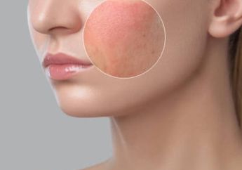 Awas! Kulit Iritasi Akibat Skincare Bisa Jadi Alergi, Segera Obati Kalau Terjadi Hal Ini